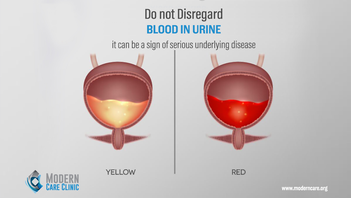 What is hematuria dr fouad khoury