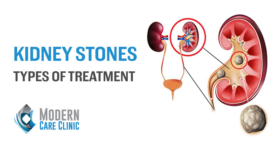 Kidney Stones
