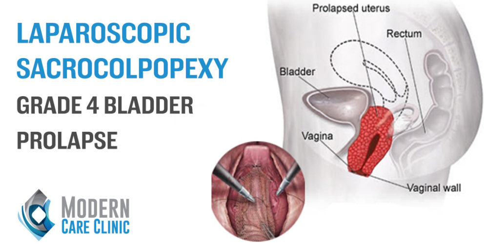 Laparoscopic Sacrocolpopexy